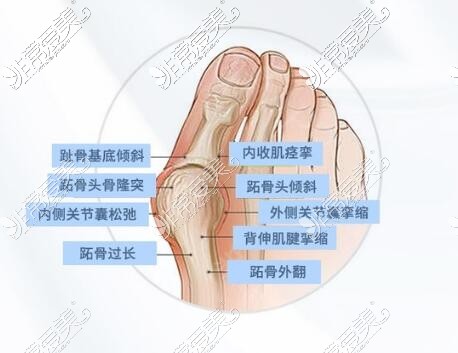 大脚骨改善照片