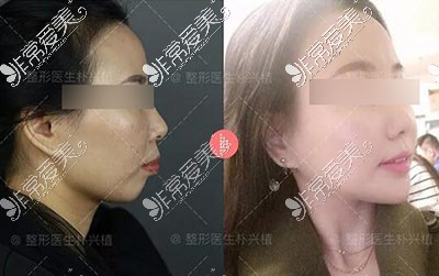 上海首尔丽格凸嘴手术前后对比照