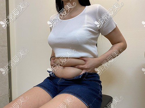 韩国芙莱思腰腹吸脂术前照片