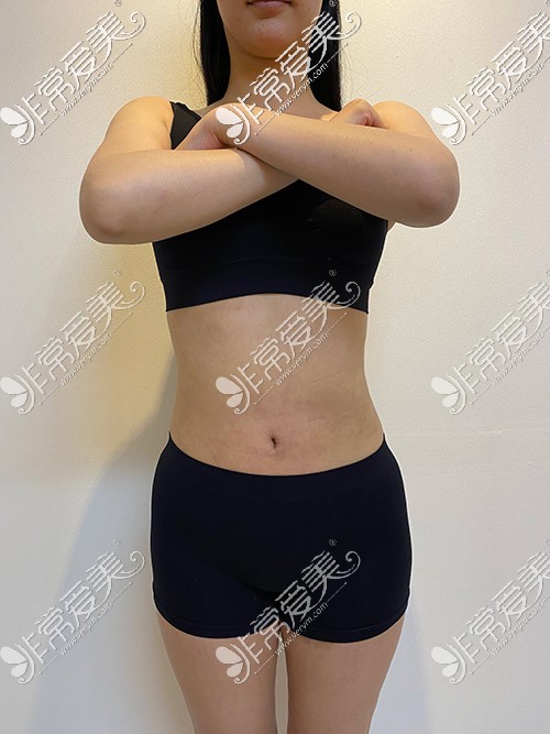芙莱思整形医院腰腹吸脂术后拆线照片