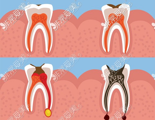 牙齿龋坏各周期图