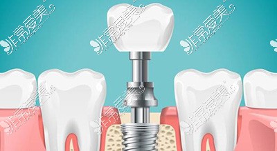 信阳种植牙改善卡通图