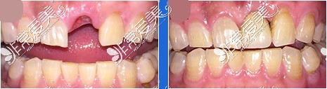 北京圣贝口腔医院种植牙对比照片