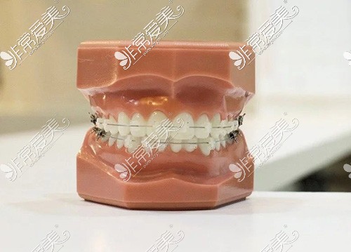 牙齿矫正模型