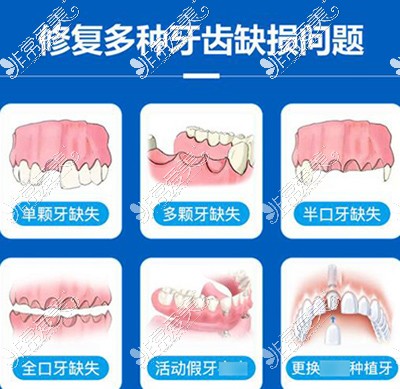 哪些缺牙类型需要进行改善