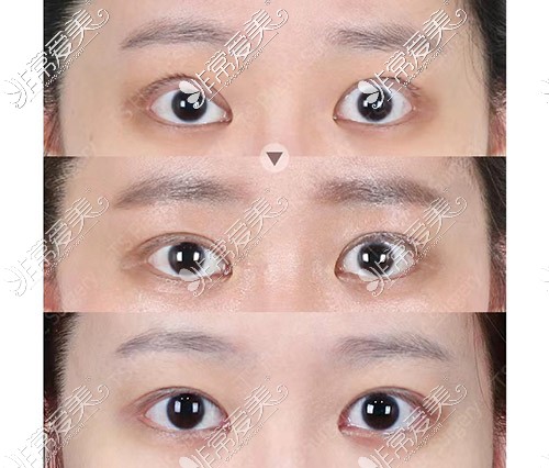 韩国TS整形医院眼肌矫正手术恢复照片
