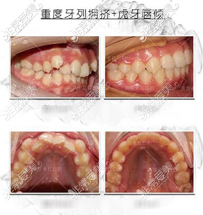 南京卡瓦口腔牙齒矯正圖