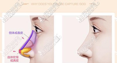 硅胶隆鼻卡通对比图