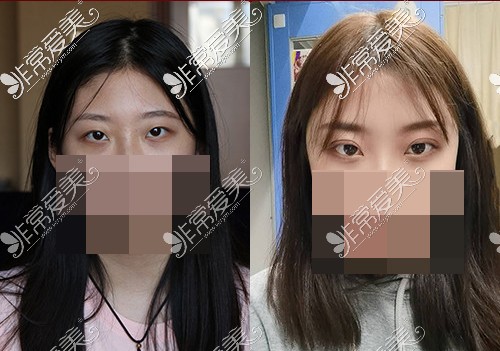 北京丽都医疗美容医院双眼皮手术对比照片
