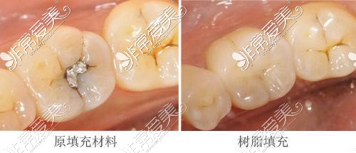 重庆补牙示意图