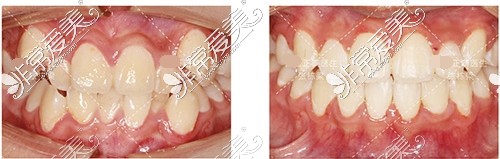 北京禾禾齒科張棟梁教授正畸對(duì)比照片