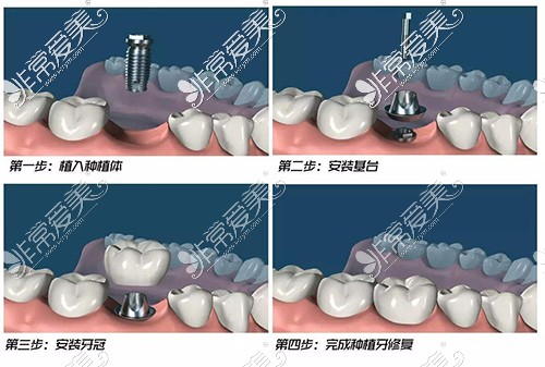 种植牙手术过程