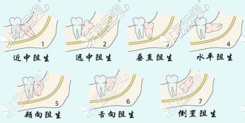 各種智齒生長(zhǎng)示意圖