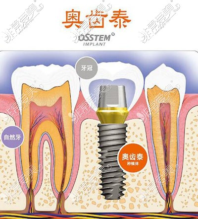 韩国奥齿泰种植牙