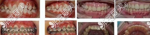 武汉仁爱口腔门诊部牙齿矫正示意图