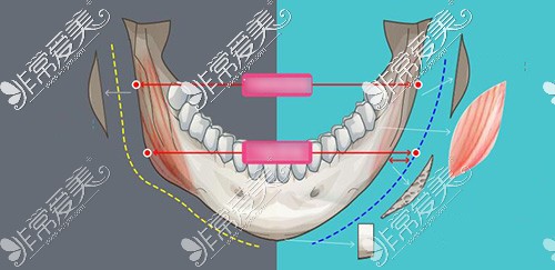 下颌角改善手术示意