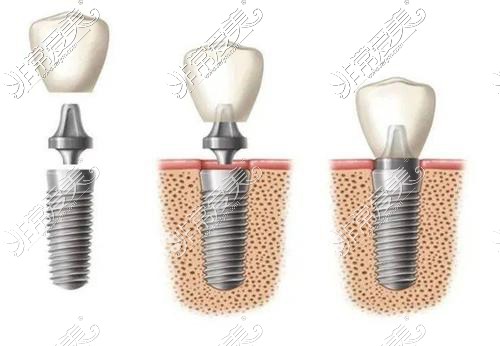 种植牙结构演示图