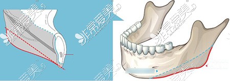 下颌角磨骨卡通图