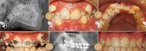 东莞好佰年口腔医院牙齿矫正示意图