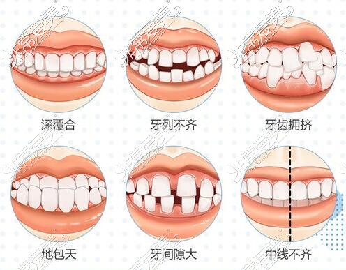 哪些牙齿需要进行矫正改善