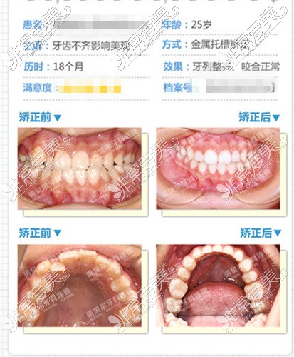 西安诺贝尔口腔金属托槽矫正