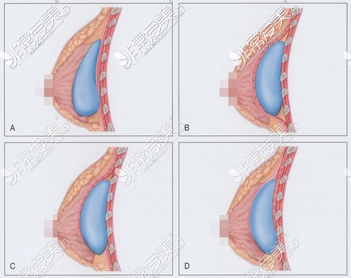 假体隆胸植入层次图
