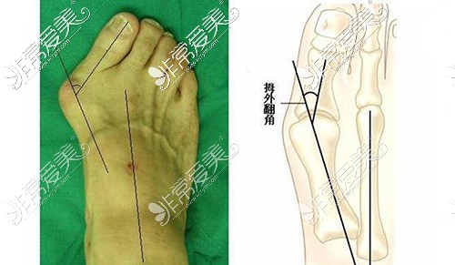 大脚骨示意图