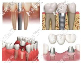 种植牙示意图