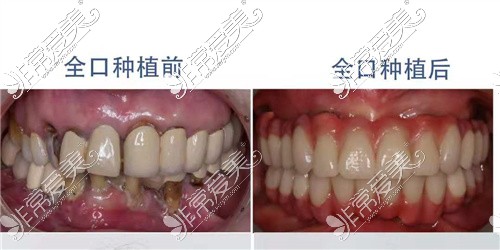 北京佳美口腔种植牙对比