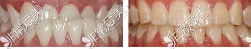 大連美爾口腔診所牙齒矯正示意圖