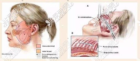 拉皮手术示意图