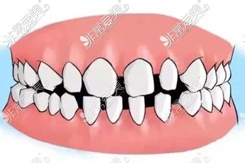 牙齿排列稀疏