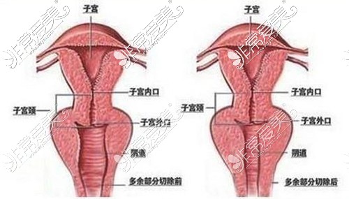 縮陰手術對比漫畫