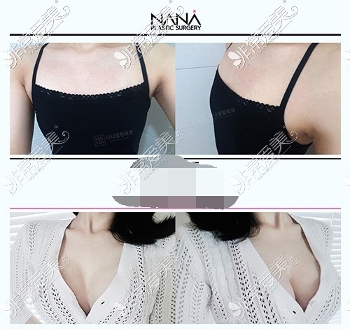 韩国NANA整形外科隆胸