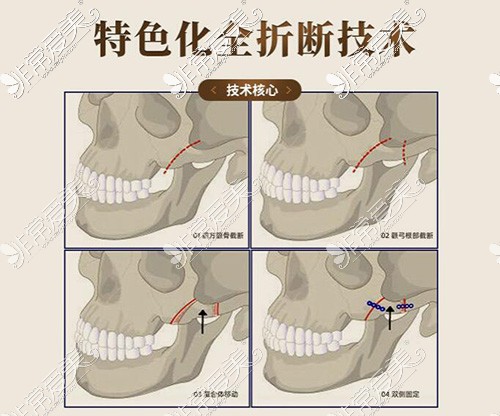 上海仁爱整形颧骨手术方法