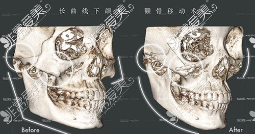上海美联臣颧骨整形术后CT图