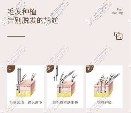 植发卡通手术改善照片