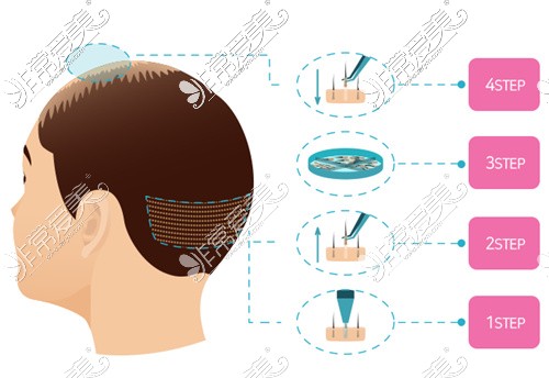 后脑勺取发移植到头顶及发际线