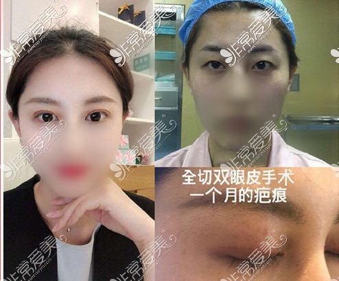 兰州时光激光整形美容医院真人双眼皮例子