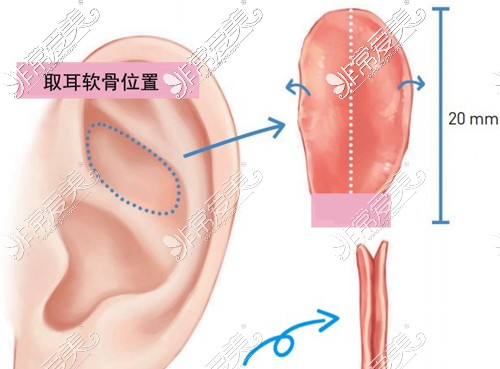 自體耳軟骨隆鼻取骨位置