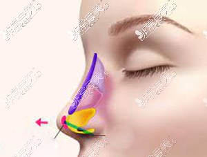 假体隆鼻图解