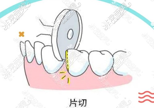 正畸片切对牙齿的影响