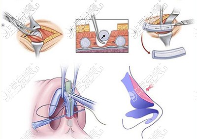 鼻整形手術(shù)示意圖