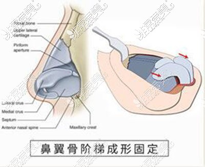 鼻整形卡通图展现