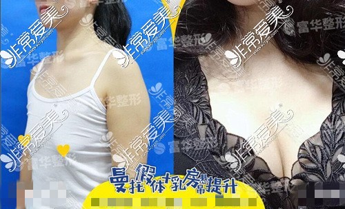 深圳富华双平面内窥镜假体隆胸对比照
