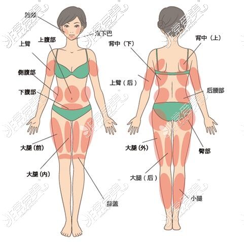 哪些部位可以進(jìn)行吸脂改善