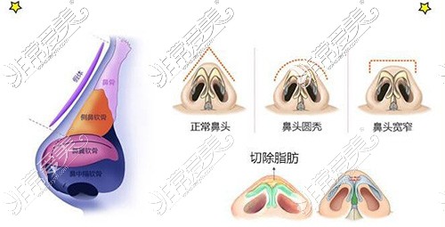 鼻整形卡通图改善照片