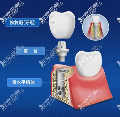 种植牙修复卡通示意图