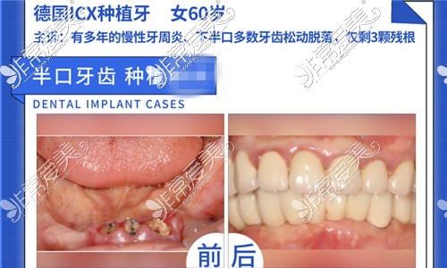 福州貝臣口腔種植牙對(duì)比