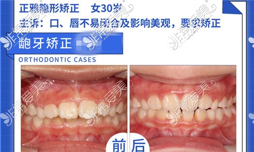 福州贝臣口腔牙齿矫正对比